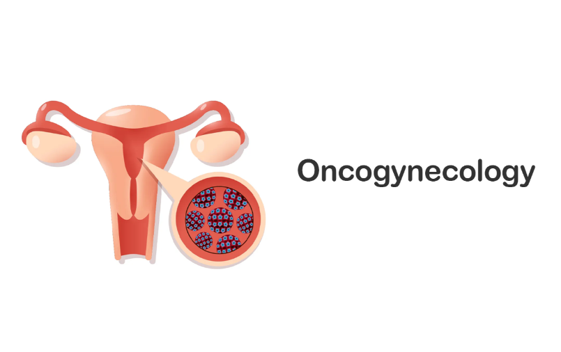 Oncogynaecology